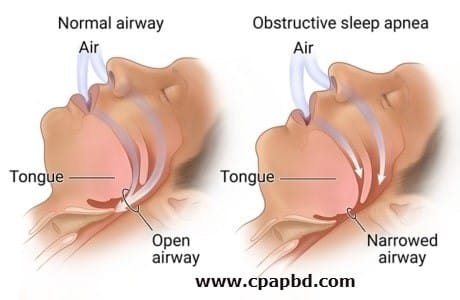Sleep apnea